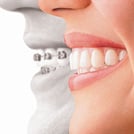 Invisalign